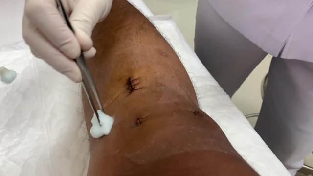 Clean the wound With alcohol after Knee Surgery The anterior cruciate ligament (ACL) is one of a pair (the other being the posterior cruciate ligament) in the human knee.