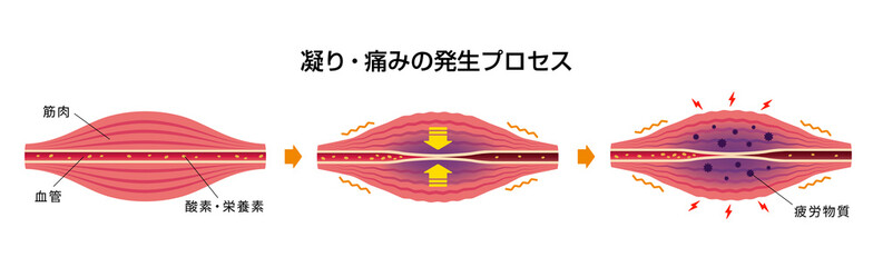 肩こり 凝り 痛みの発生原因イラスト Wall Mural Barks