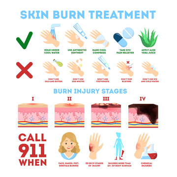 Skin Burn Injury Treatment And Stages Infographic