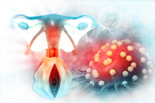 uterine cancer 3d render