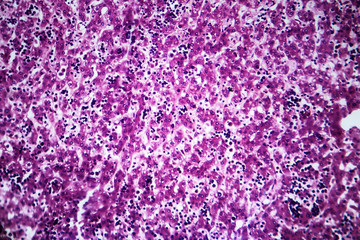 Obraz premium Histopathology of chronic active hepatitis, light micrograph, photo under microscope