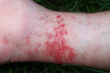 Rash on the skin after biting a bee