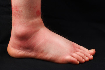 Leg after bite of a bee