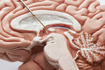 Concept of brain recording in subthalamic nucleus for Parkinson disease surgery.