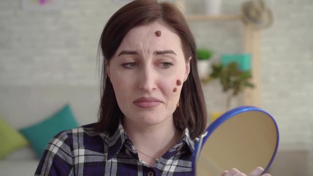 Young upset woman with moles on her face looking in the mirror