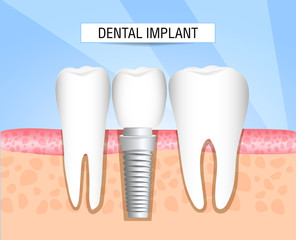 Realistic dental implant structure with all parts: crown, abutment, screw. Healthy teeth and dental implant. Dentistry. Implantation of human teeth. Vector illustration