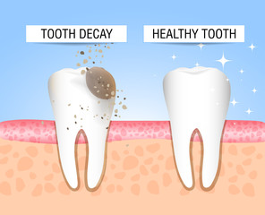 The concept of healthy and diseased tooth. Visual aid for students, dentists, patients of the clinic. Defeat caries, the focus of destruction in the teeth. Vector illustration
