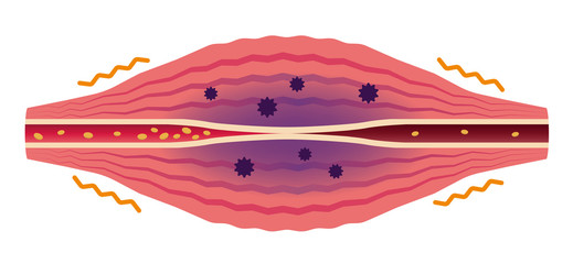 Fatigue factors accumulate (No text) . Flat illustration of muscle and vessel. 