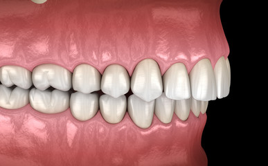 Overbite dental occlusion ( Malocclusion of teeth ). Medically accurate tooth 3D illustration