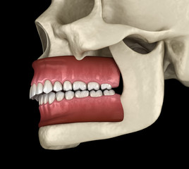 Overbite dental occlusion ( Malocclusion of teeth ). Medically accurate tooth 3D illustration - obrazy, fototapety, plakaty