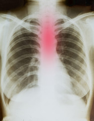 Body radiography Reflux symbol