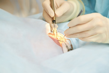Obraz premium Ophthalmology laser microscope operation. Doctor in clinic. Patient eye treatment. Myopia and cataract removal