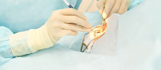 Ophthalmology laser microscope operation. Doctor in clinic. Patient eye treatment. Myopia and cataract removal