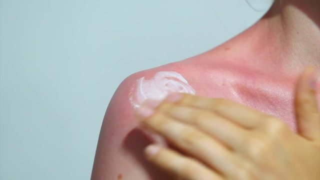 a young girl rubs her shoulder ointment after sunburn isolated