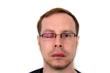 Obraz premium ein Mann mit geschwollenem Auge und dicker Lippe von einem Bienenstich