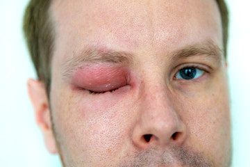 ein Mann mit geschwollenem Auge von einem Bienenstich