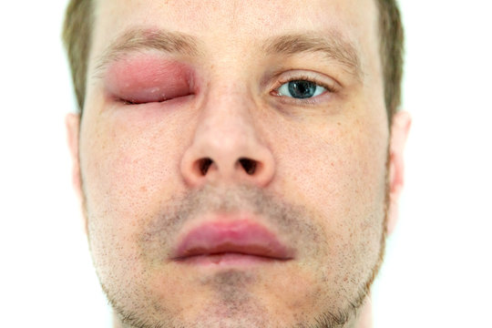 ein Mann mit geschwollenem Auge und dicker Lippe von einem Bienenstich