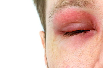 ein Mann mit geschwollenem Auge von einem Bienenstich