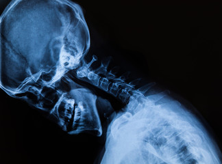 Cervical X-ray film