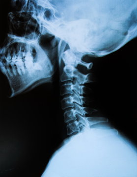 Cervical X-ray film