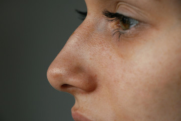 blackheads on the nose of a teenager closeup