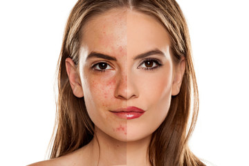 Comparison portrait of young beautiful woman before and after skin treatment and makeup on white...