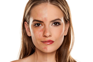 Comparison portrait of young beautiful woman before and after skin treatment and makeup on white backgeound