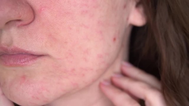 A young woman with problem skin looks at her face. Allergic reaction food intolerance to acne and skin damage, without retouching close-up
