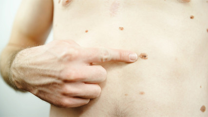 Person show a dangerous mole on skin