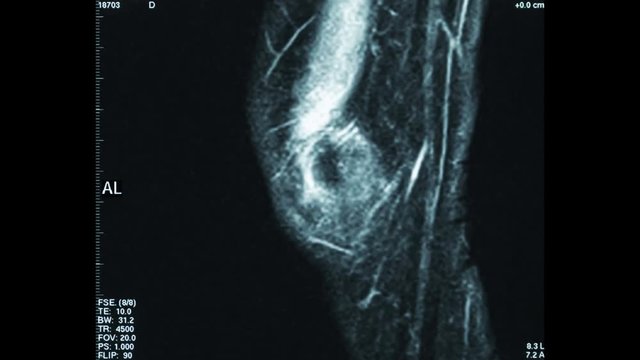 Time Lapse video animation of R.M.N. Nuclear magnetic resonance, of human knees, with cross-section and sagittal section.