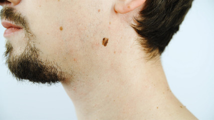 Big skin mole on male neck