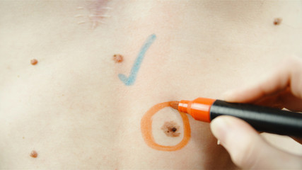 Melanoma skin mole and healthy mole