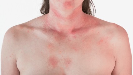 Allergic skin reaction on the female neck and face - red rash - obrazy, fototapety, plakaty