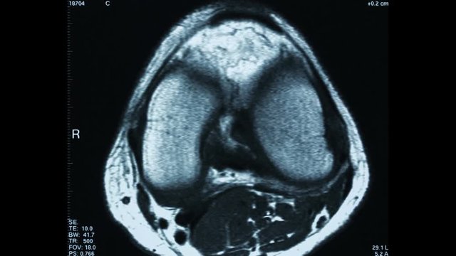 Time Lapse video animation of R.M.N. Nuclear magnetic resonance, of human knees, with cross-section and sagittal section.