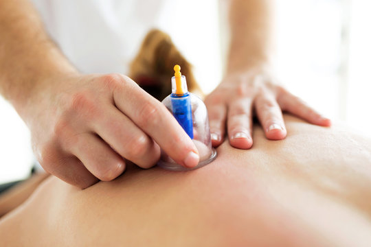 Physiotherapist applying cupping treatment to the patient in a physiotherapy room.