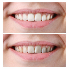 Woman Teeth Before and After Whitening on isolated white background
