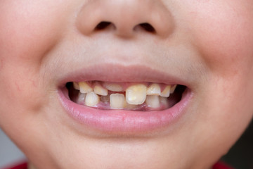 little child and broken teeth