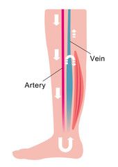 Cause of swelling(edema) of the legs. Water in the blood stagnates and venous pressure rises. flat illustration.