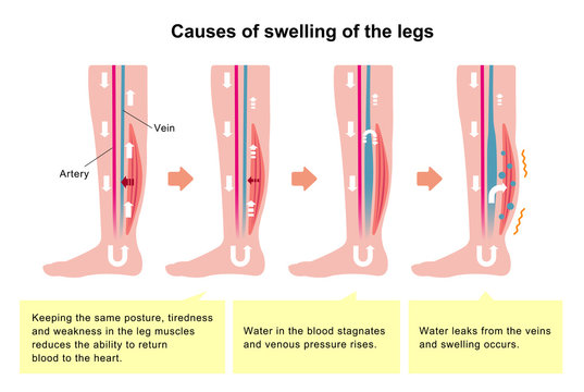 Cause of swelling(edema) of the legs. flat illustration (with explanation text).