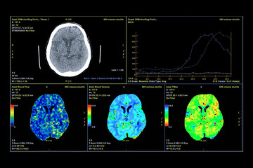 Perfusion CT scan of the brain ,The red and green and blue are areas of delayed blood flow to the...
