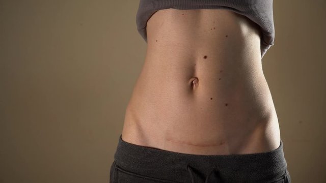 C section Cesarean operation heal after mother holding baby postpartum recovery