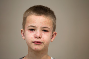 Fototapeta premium Portrait of sick sad boy child suffering from measles or chicken pox with bumps all over face. Contagious child diseases and treatment.