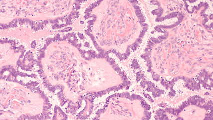 Microscopic image of an atypical proliferative (borderline) serous tumor of the ovary (low...