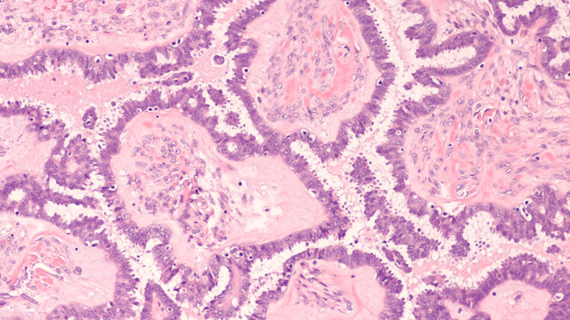 Microscopic image of an atypical proliferative (borderline) serous tumor of the ovary (low malignant potential) with branching papillae lined by stratified cells with nuclear atypia. 