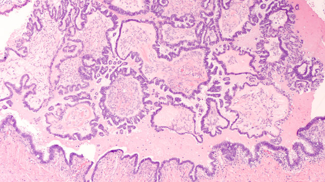 Microscopic image of an atypical proliferative (borderline) serous tumor of the ovary (low malignant potential) with branching papillae lined by stratified cells with nuclear atypia. 