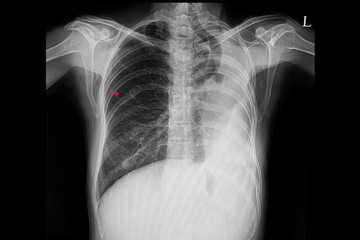 A chest xray of a patient after left lung thoracotomy.