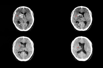 Ct brain of metastatic cancer