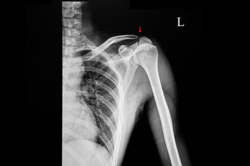 X ray of a patient with fracture acromion