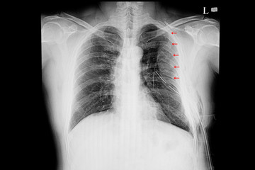 chest xray  film of a patient with multiple rib fractures