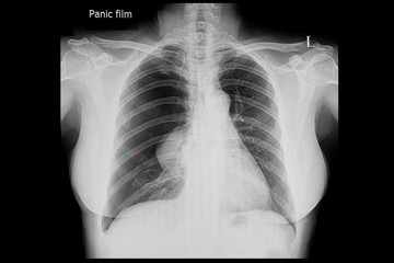 Chest X ray film of a patient with pneumothorax